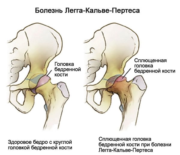 coxarthrosis deformáló artrosis kezelés