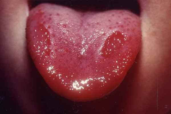 nyelv vörös foltokban egy felnőtt kezelés során