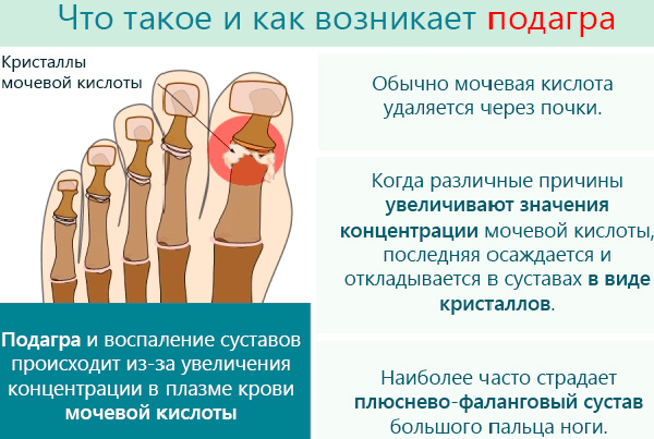 Traitement de la lithiase urinaire - élimination de l'acide urique en cas de goutte