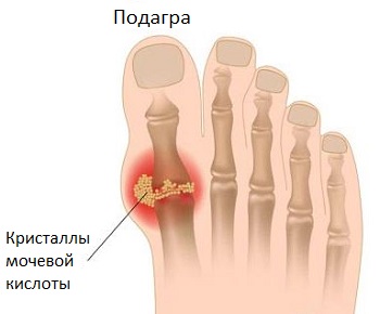 fájdalom a nagy lábujj metatarsofalangealis ízületében)