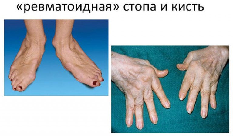 tratament de genunchi albastru