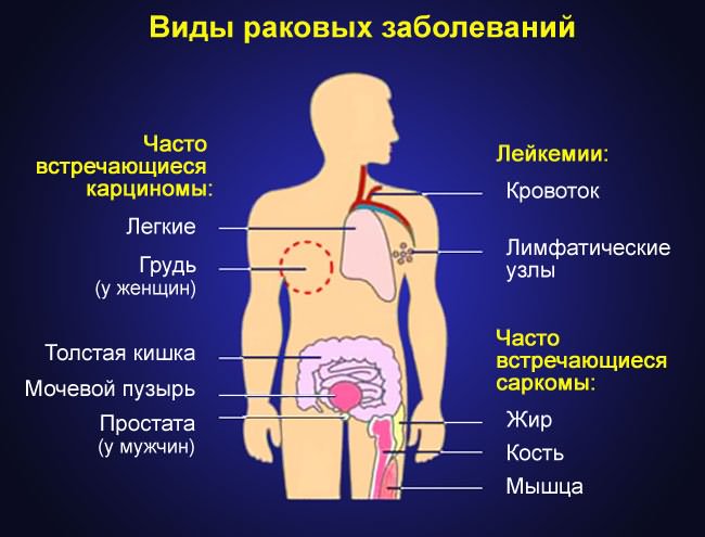 a kis ízületek deformáló artrózisa)