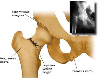 csípőízület 4. stádiumának artrózisa