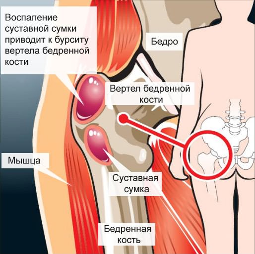 a csípőízületek deformáló artrózisa 1 evőkanál)