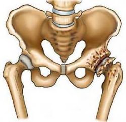 Deformáló arthrosis A csípőízület 1, 2 fok okoz, a tünetek, a kezelés