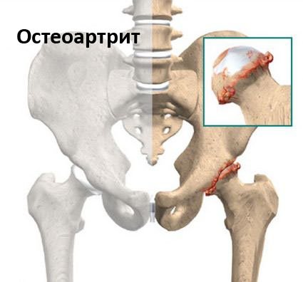 Coxarthrosis 1 fok, a csípőízület kezelése - Osteoarthritis