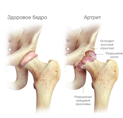 a térd deformáló artrózisának kezelése 2 szakaszban